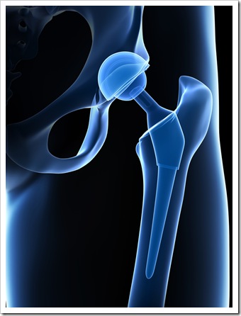 Back Pain West Caldwell NJ Joint Replacement