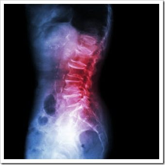 Back Pain Caldwell NJ Arthritis