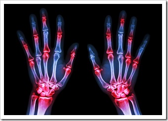 Rheumatoid Caldwell NJ Arthritis Solutions