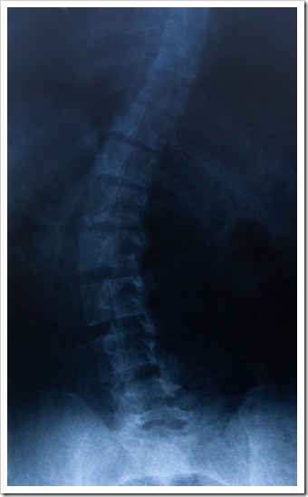 Scoliosis Caldwell